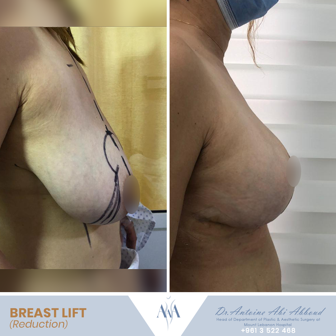 Breast Reduction before and after — case 5