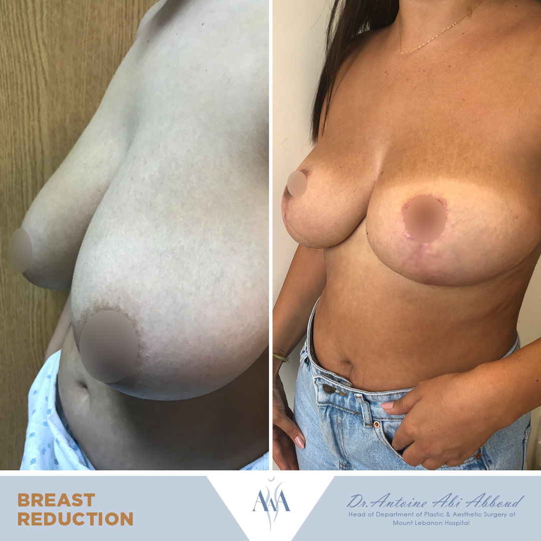Breast Reduction before and after — case 2