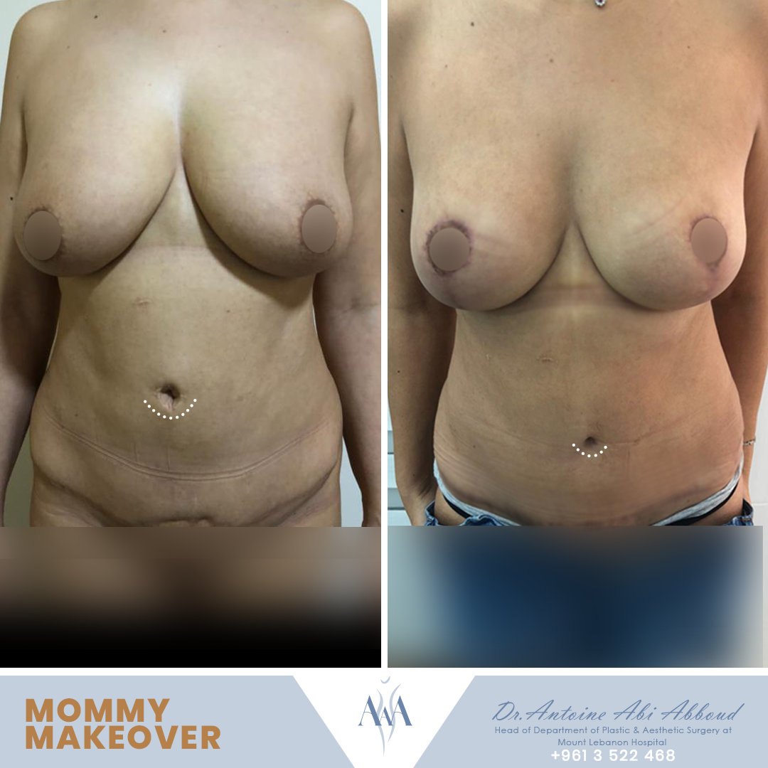 Abdominoplasty before and after — case 6