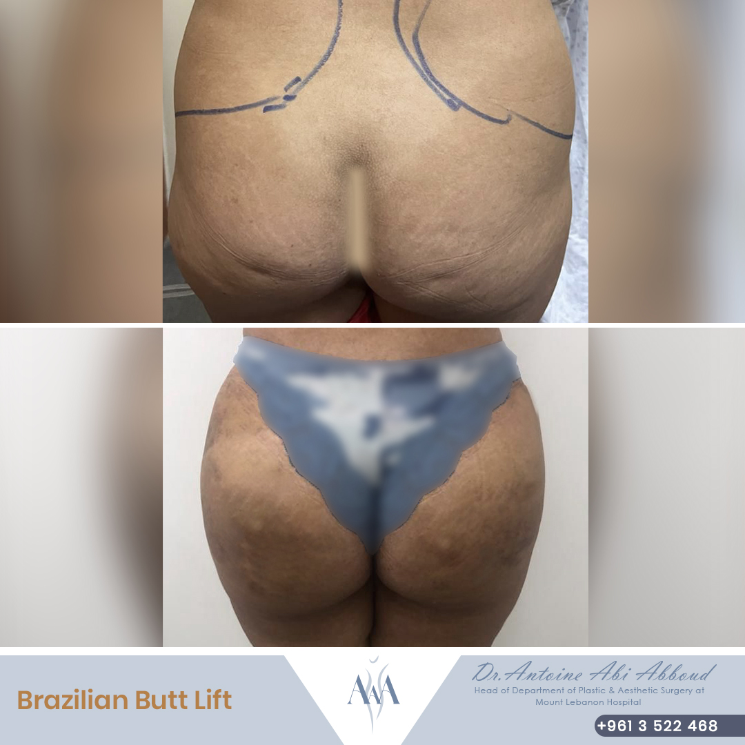 Butt Lipofilling before and after — case 2