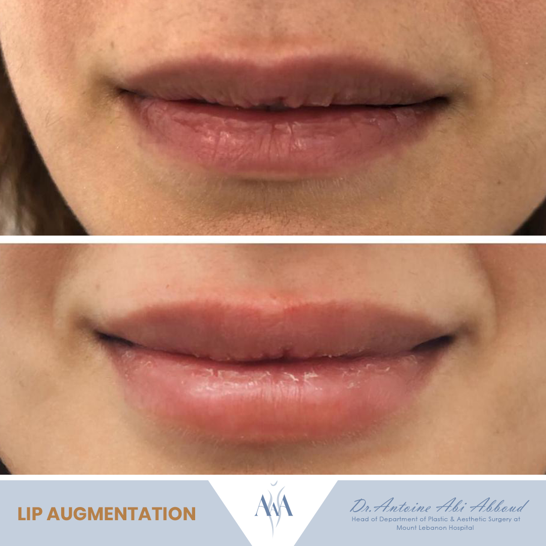 Fillers before and after — case 5