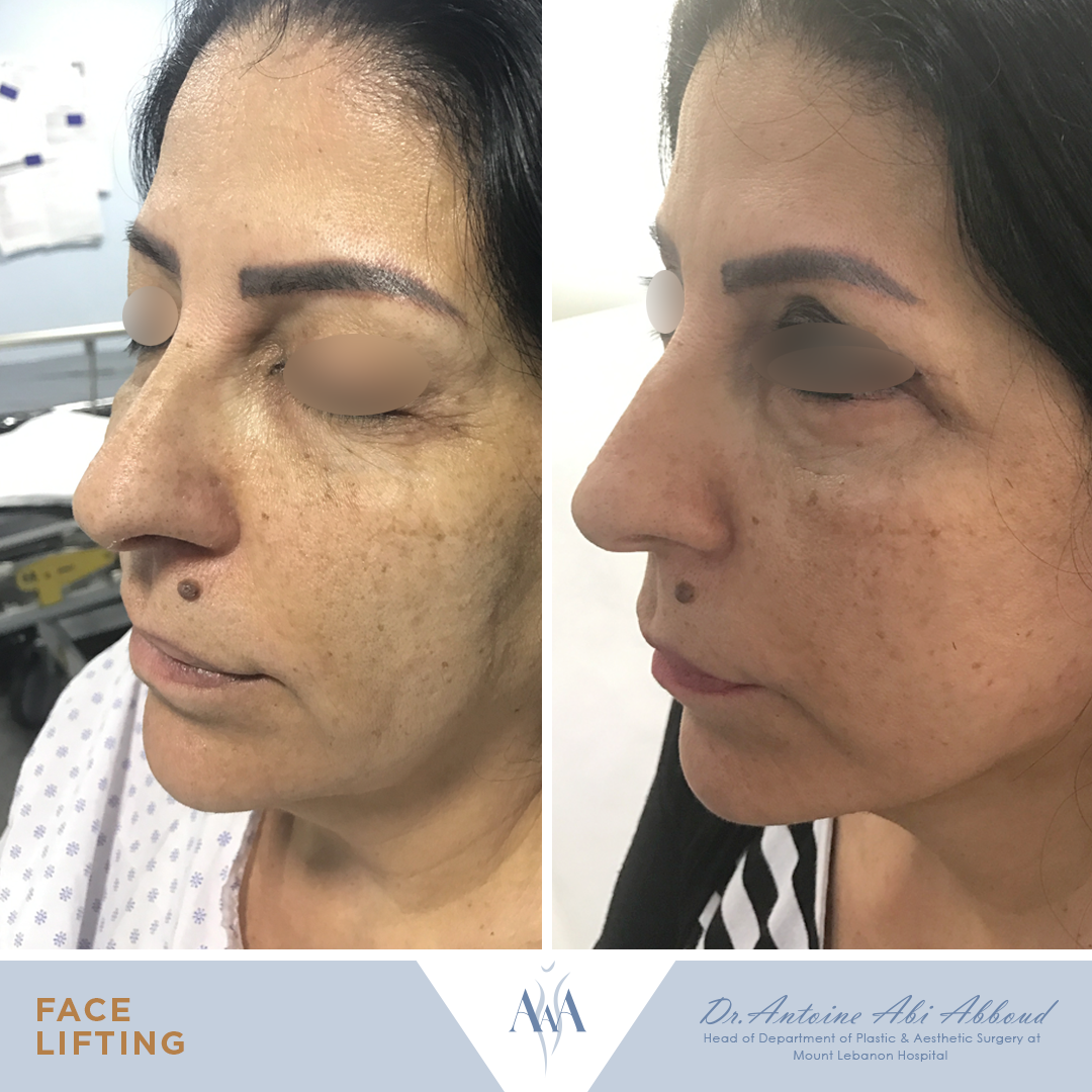 Face & Neck Lift before and after — case 7