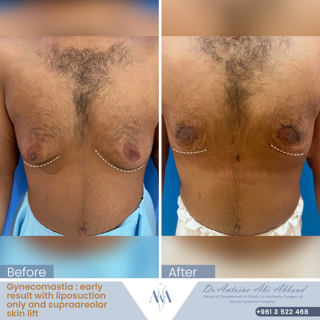 Gynecomastia before and after — case 5