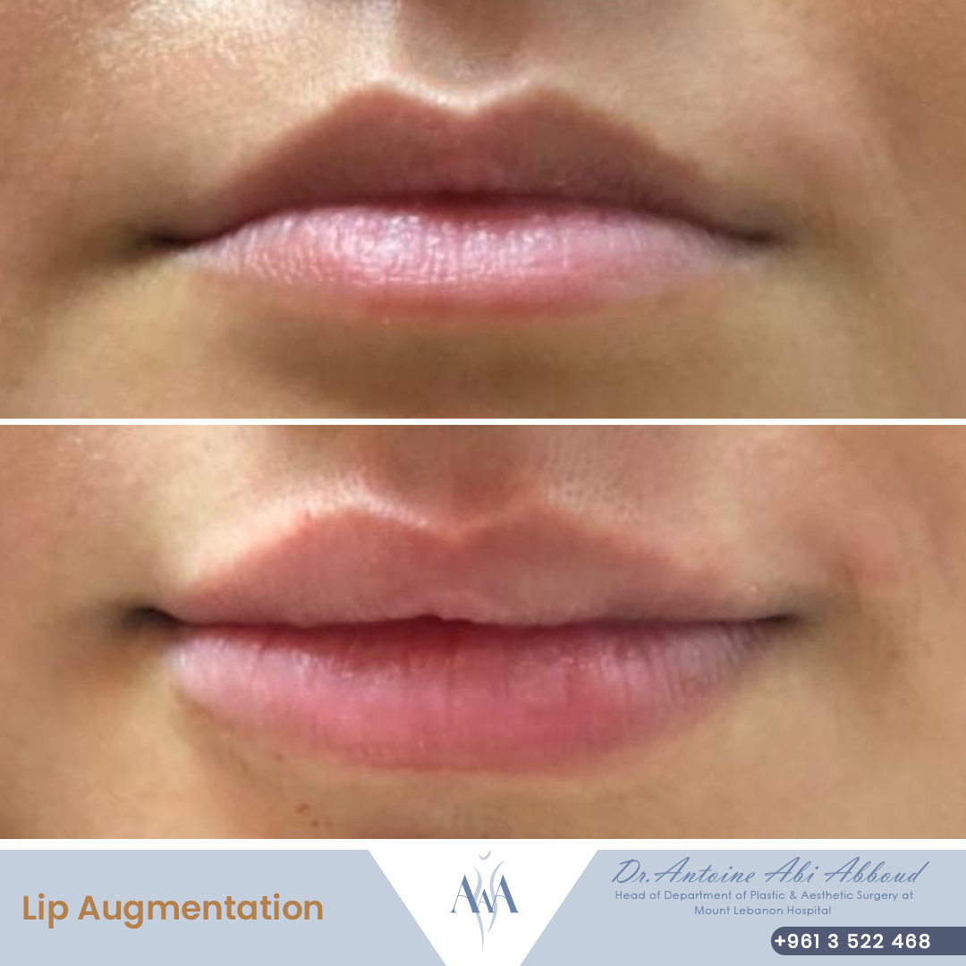 Fillers before and after — case 4