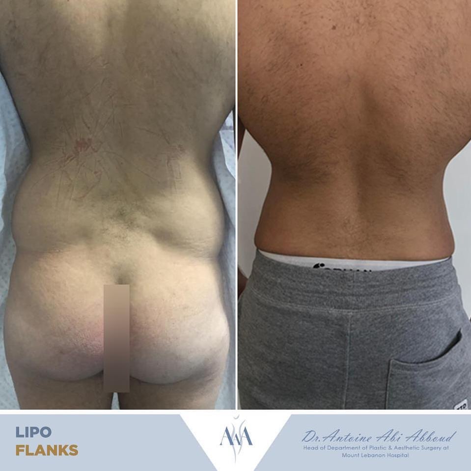 Liposuction before and after — case 2