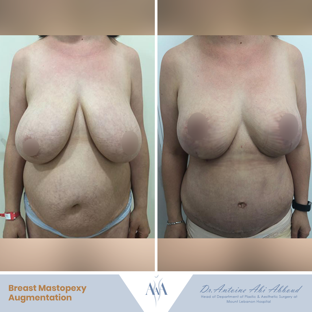 Breast Reduction before and after — case 8