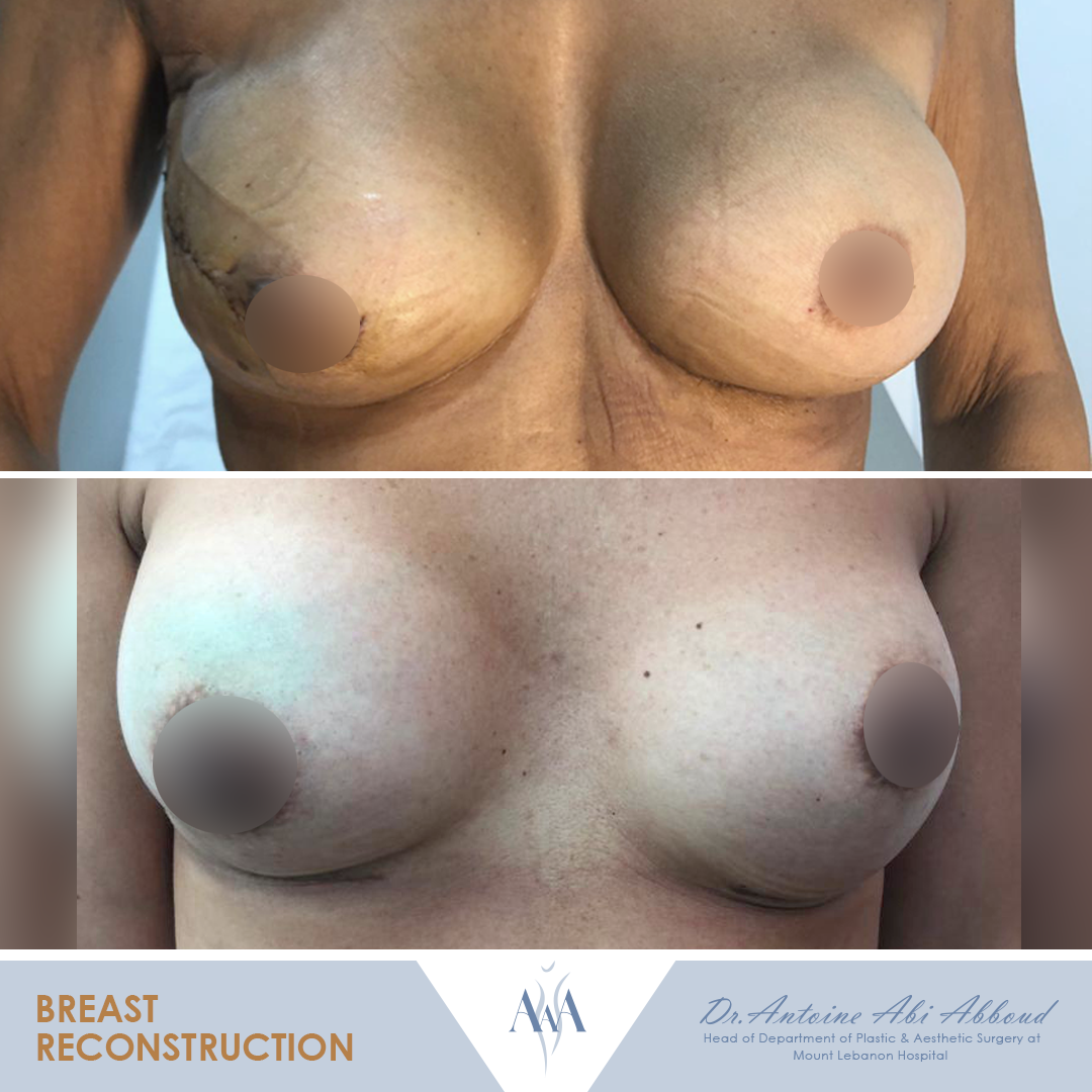 Breast Reconstruction before and after — case 1