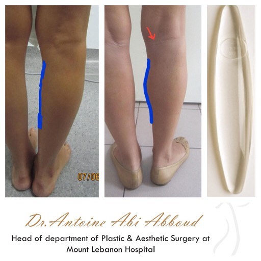 Calf Augmentation before and after — case 2