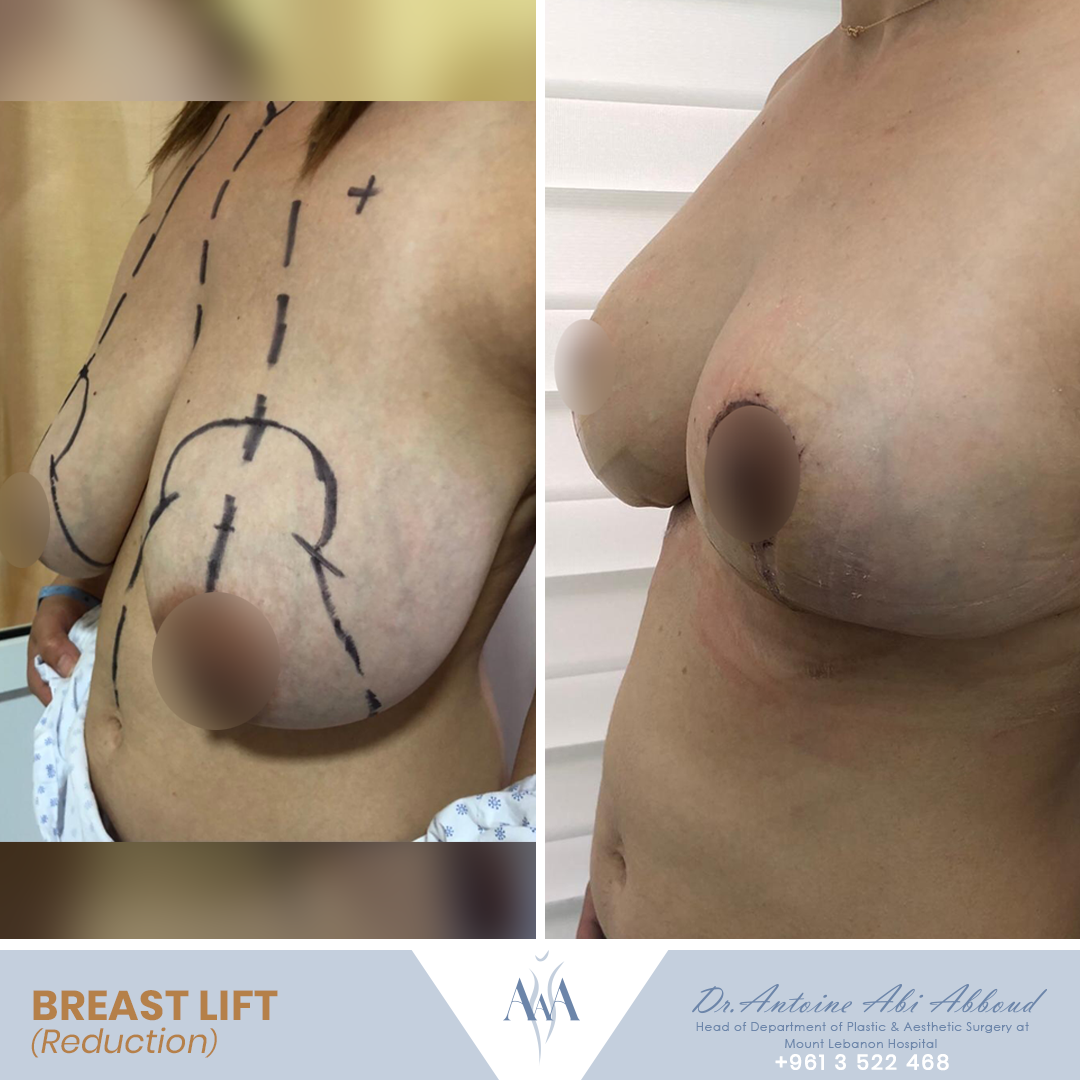 Breast Reduction before and after — case 4