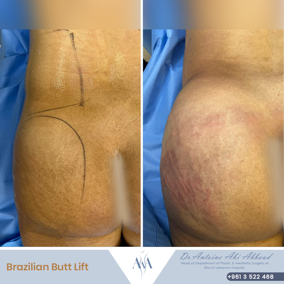 Butt Lipofilling before and after — case 3