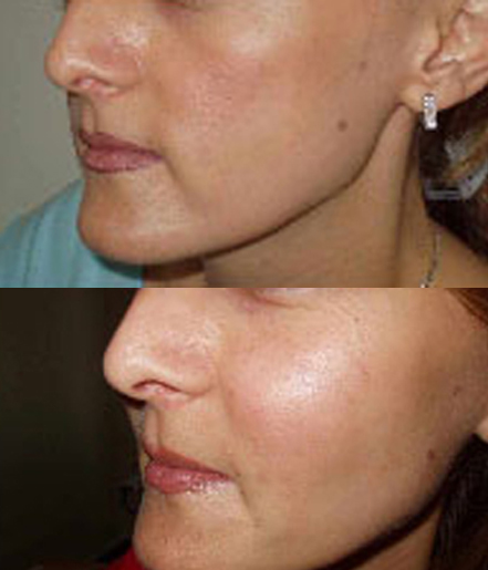 Lipofilling before and after — case 1