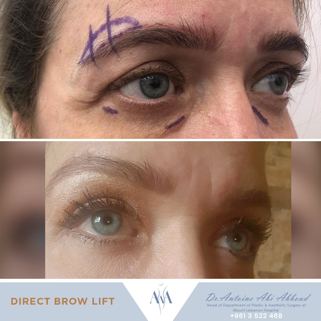 Brow Lift before and after — case 2