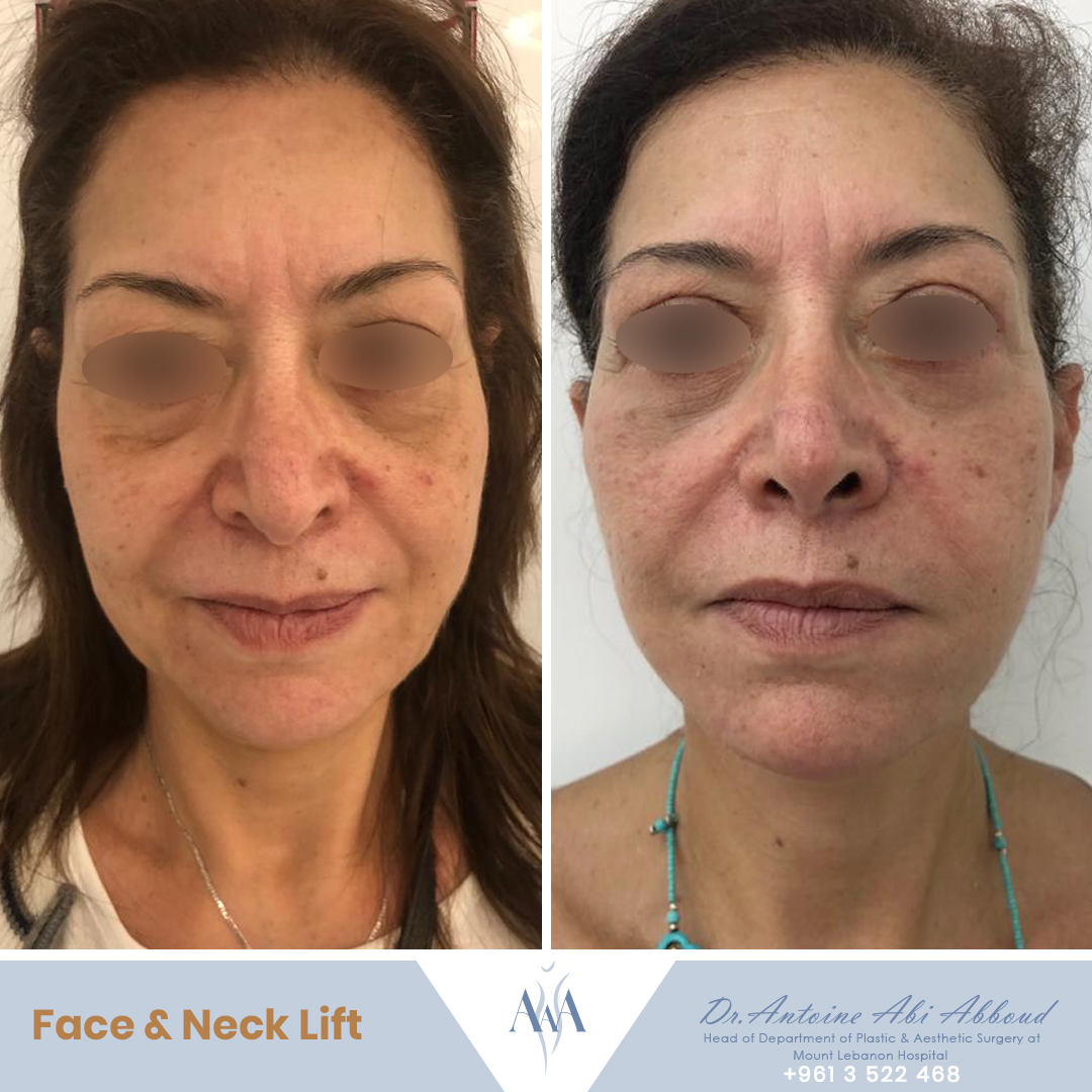 Face & Neck Lift before and after — case 5