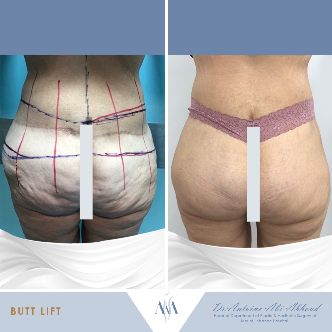 Butt Lift before and after — case 5