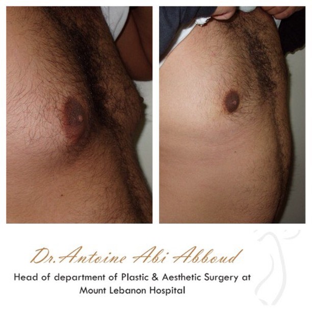 Liposuction before and after — case 4
