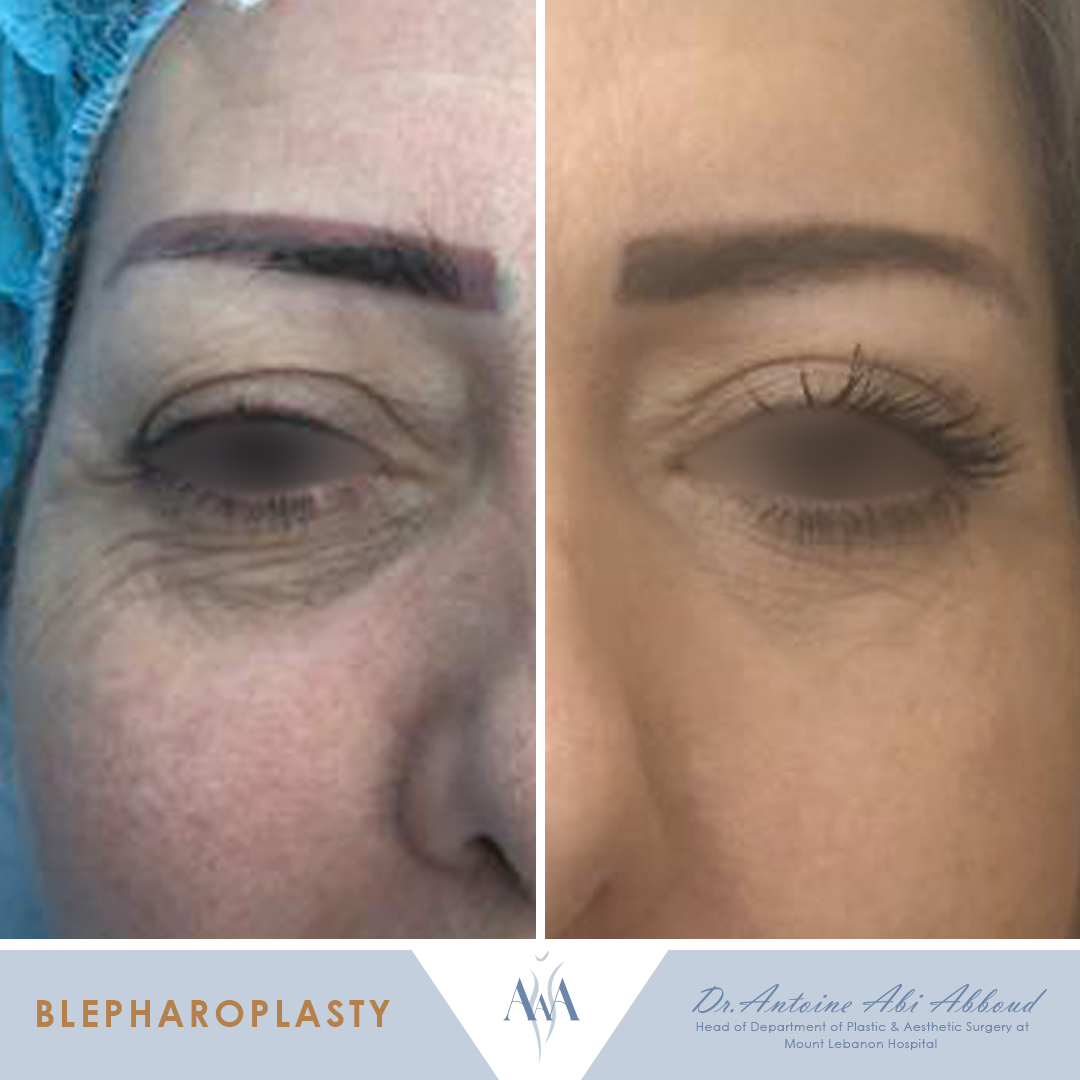 Blepharoplasty before and after — case 3