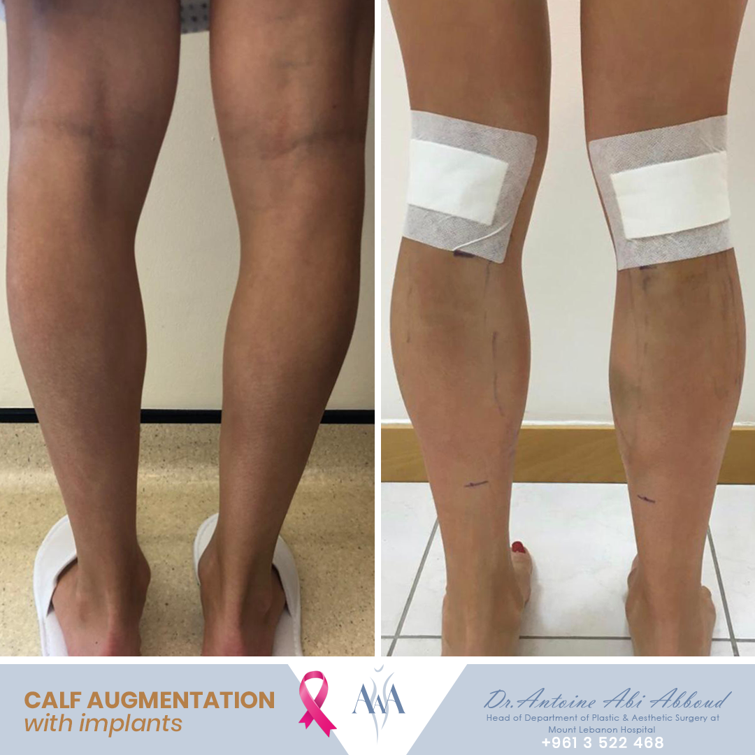 Calf Augmentation before and after — case 3
