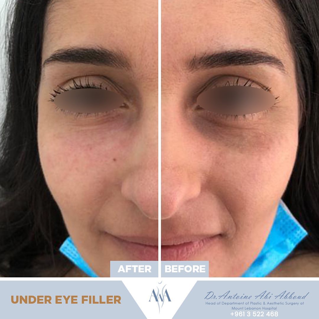 Fillers before and after — case 2