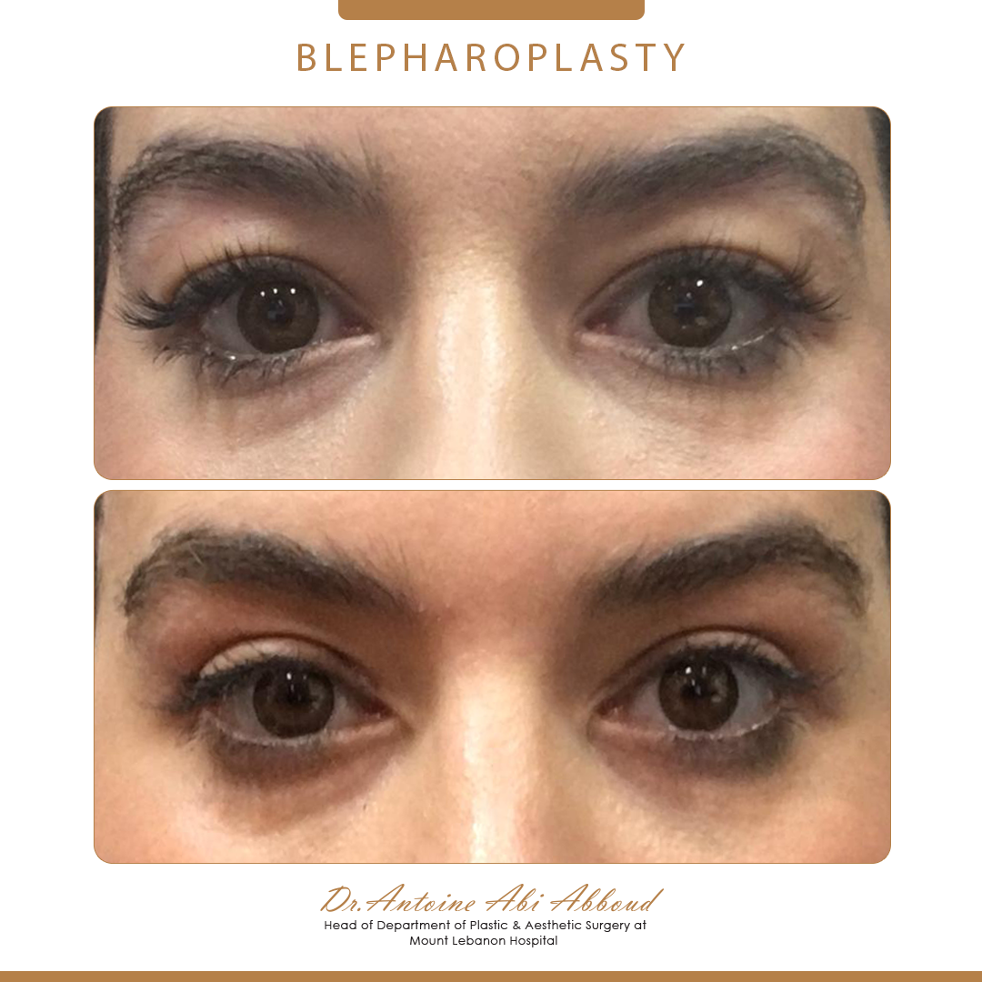 Blepharoplasty before and after — case 5
