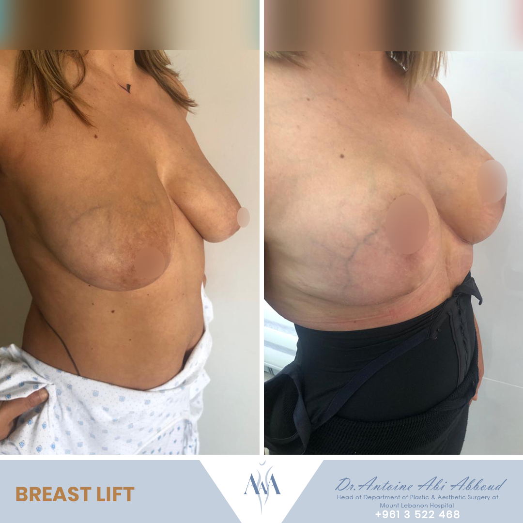 Mastopexy (Breast Lift) before and after — case 2