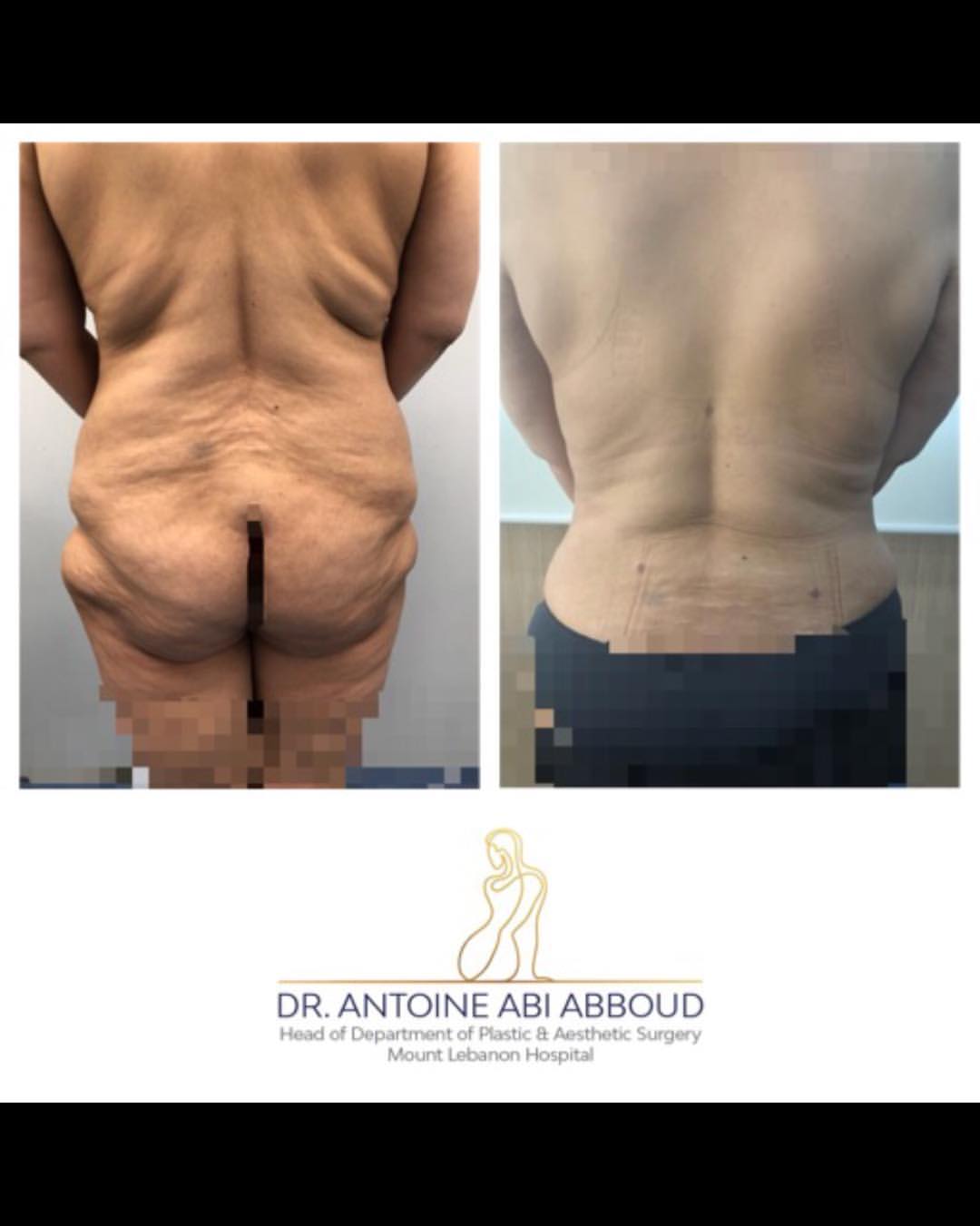 Liposuction before and after — case 6