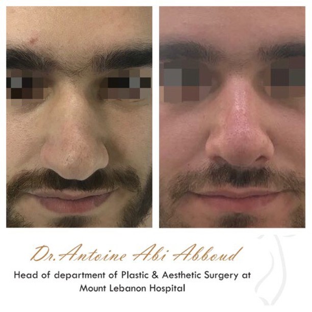 Nose Surgery before and after — case 5