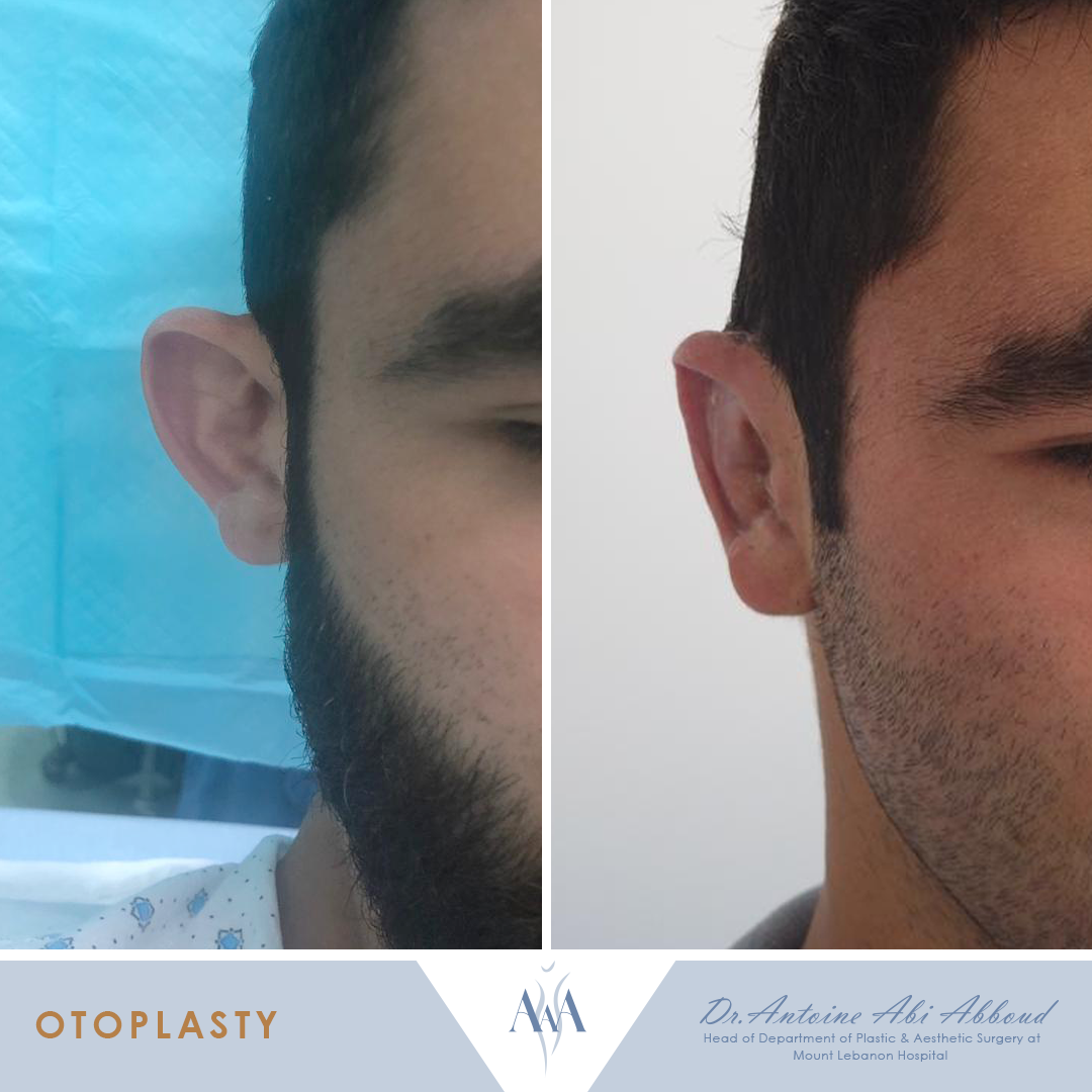 Otoplasty before and after — case 1