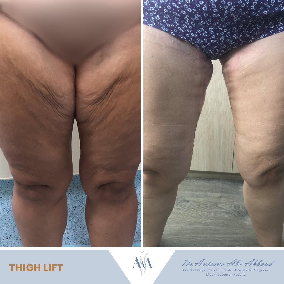 Thigh Lift before and after — case 3
