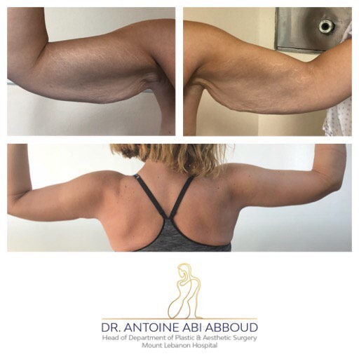 Arm Lift before and after — case 1