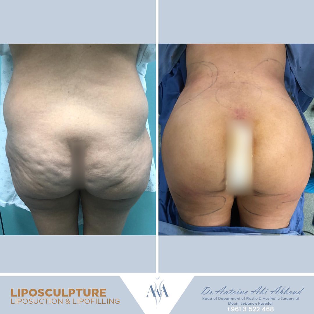 Liposuction before and after — case 3