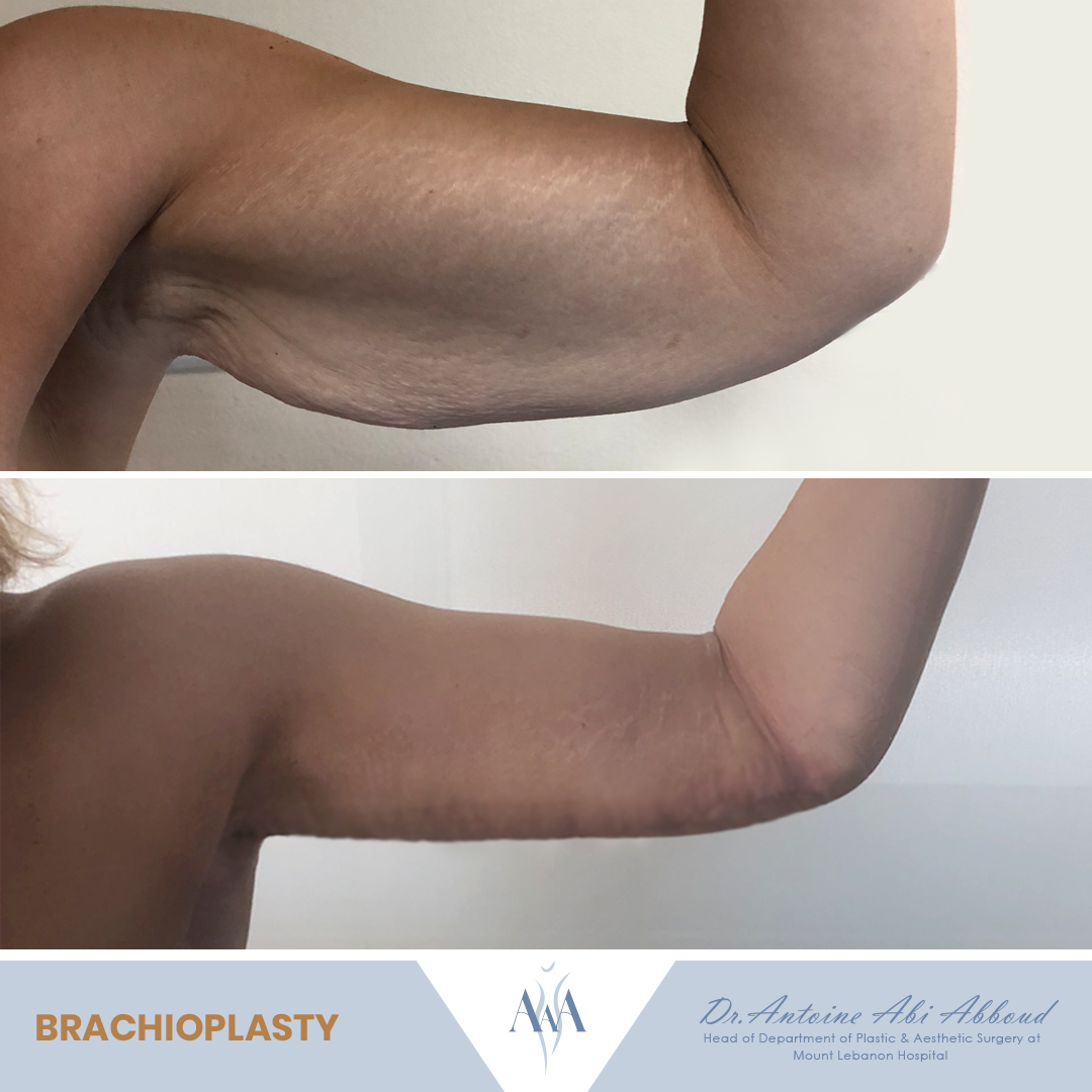 Arm Lift before and after — case 4