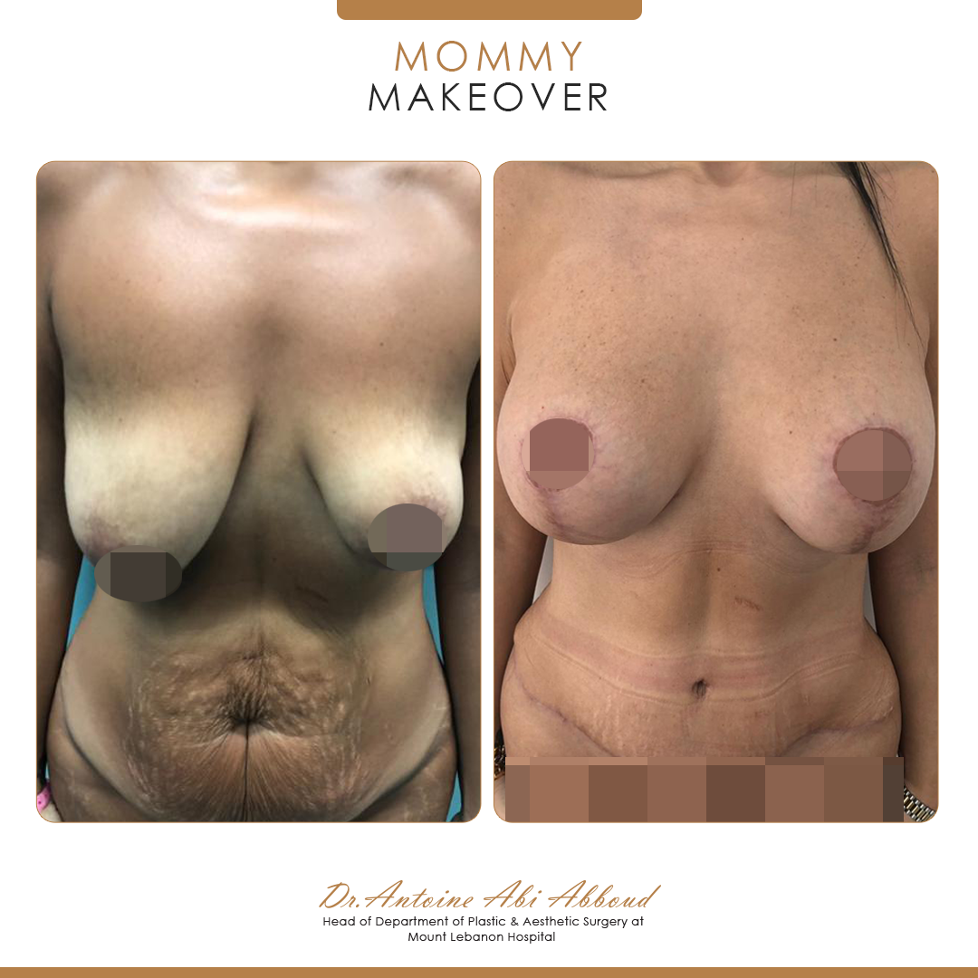 Mommy Makeover before and after — case 8