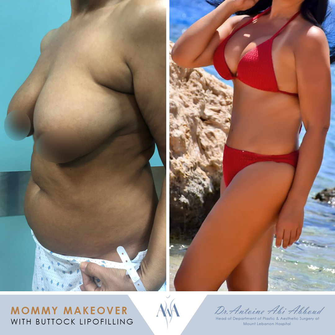 Mommy Makeover before and after — case 5