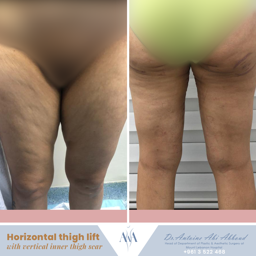 Thigh Lift before and after — case 2