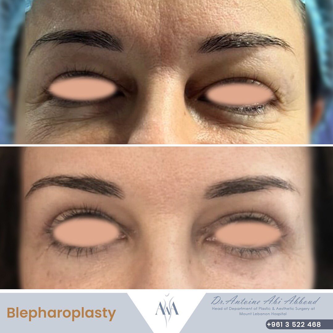 Blepharoplasty before and after — case 1