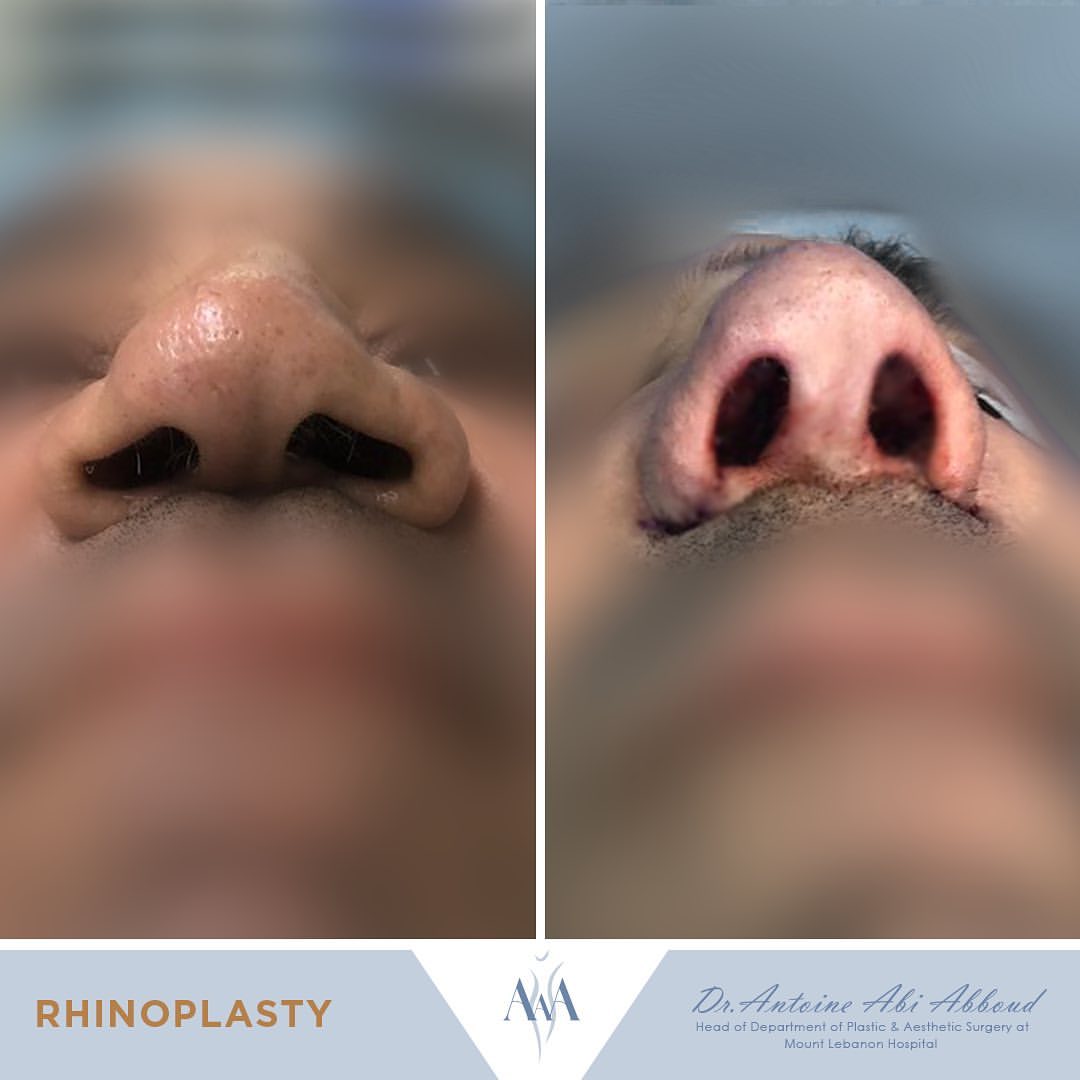 Nose Surgery before and after — case 6