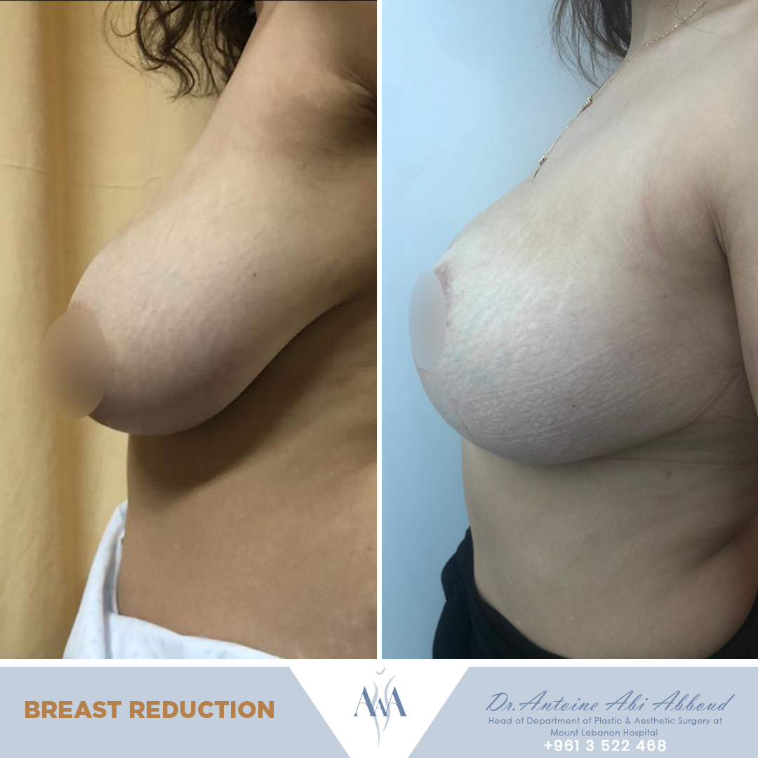 Breast Reduction before and after — case 6