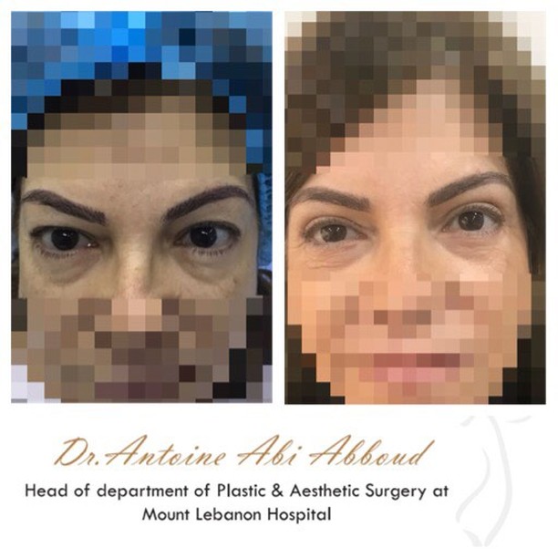 Blepharoplasty before and after — case 2