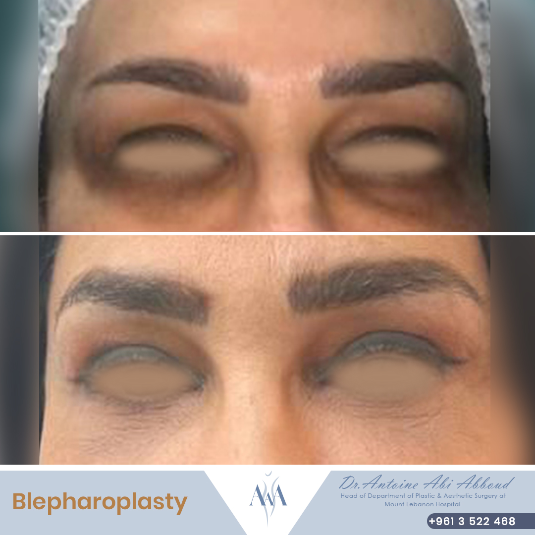 Blepharoplasty before and after — case 8
