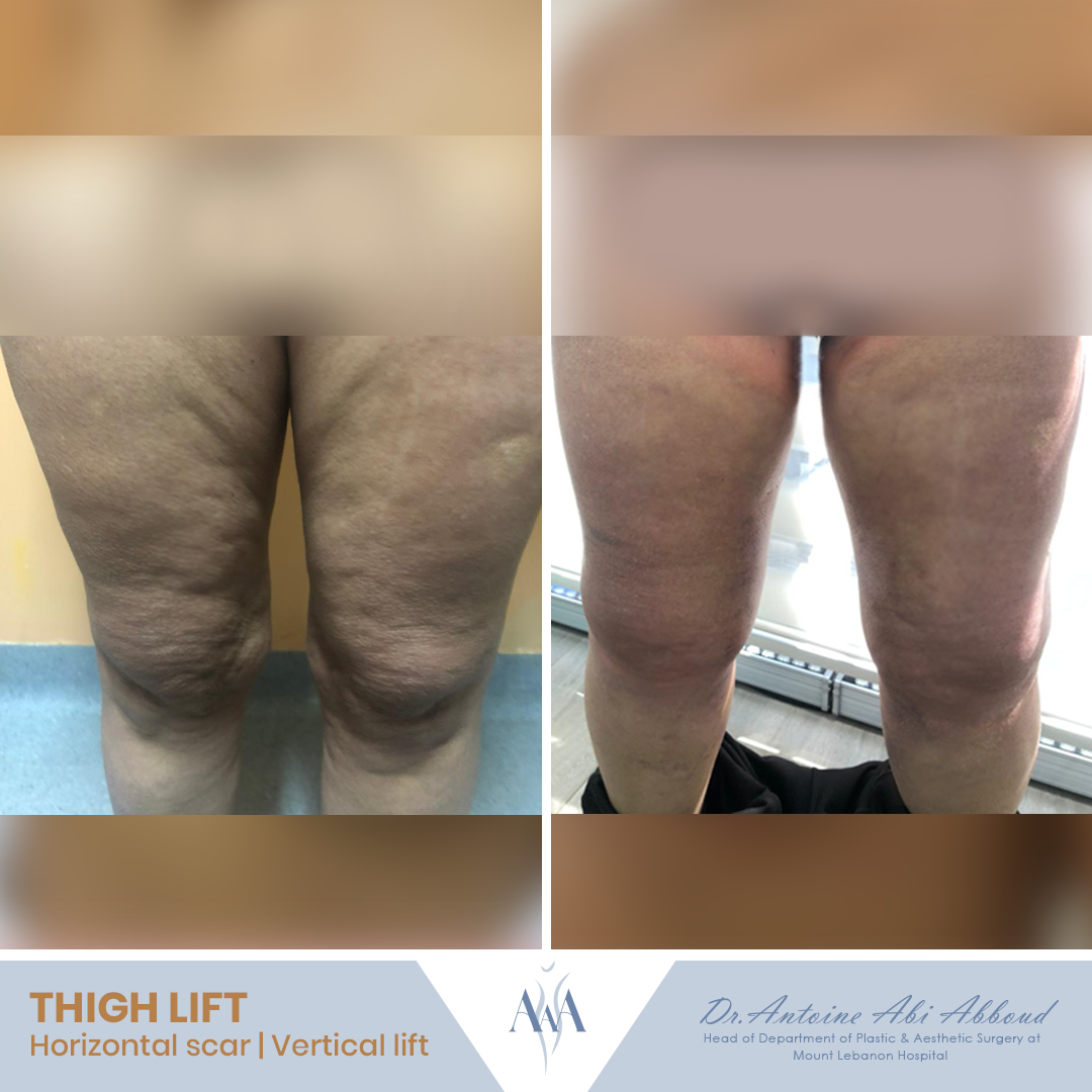 Thigh Lift before and after — case 5