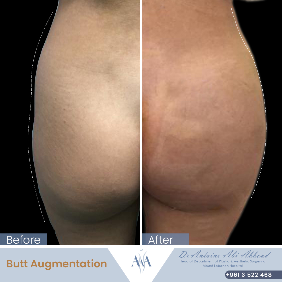 Butt Lipofilling before and after — case 6