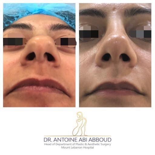Nose Surgery before and after — case 1