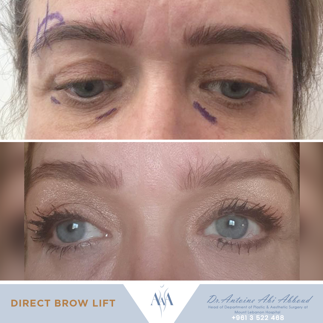 Brow Lift before and after — case 1