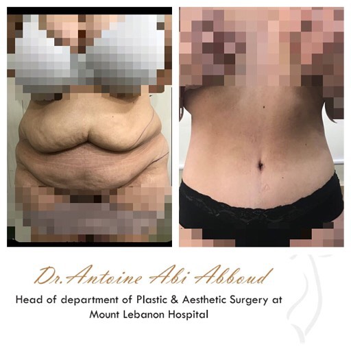 Abdominoplasty before and after — case 4
