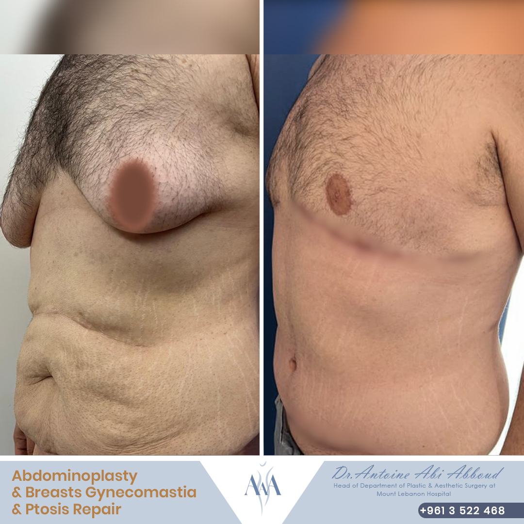 Gynecomastia before and after — case 4