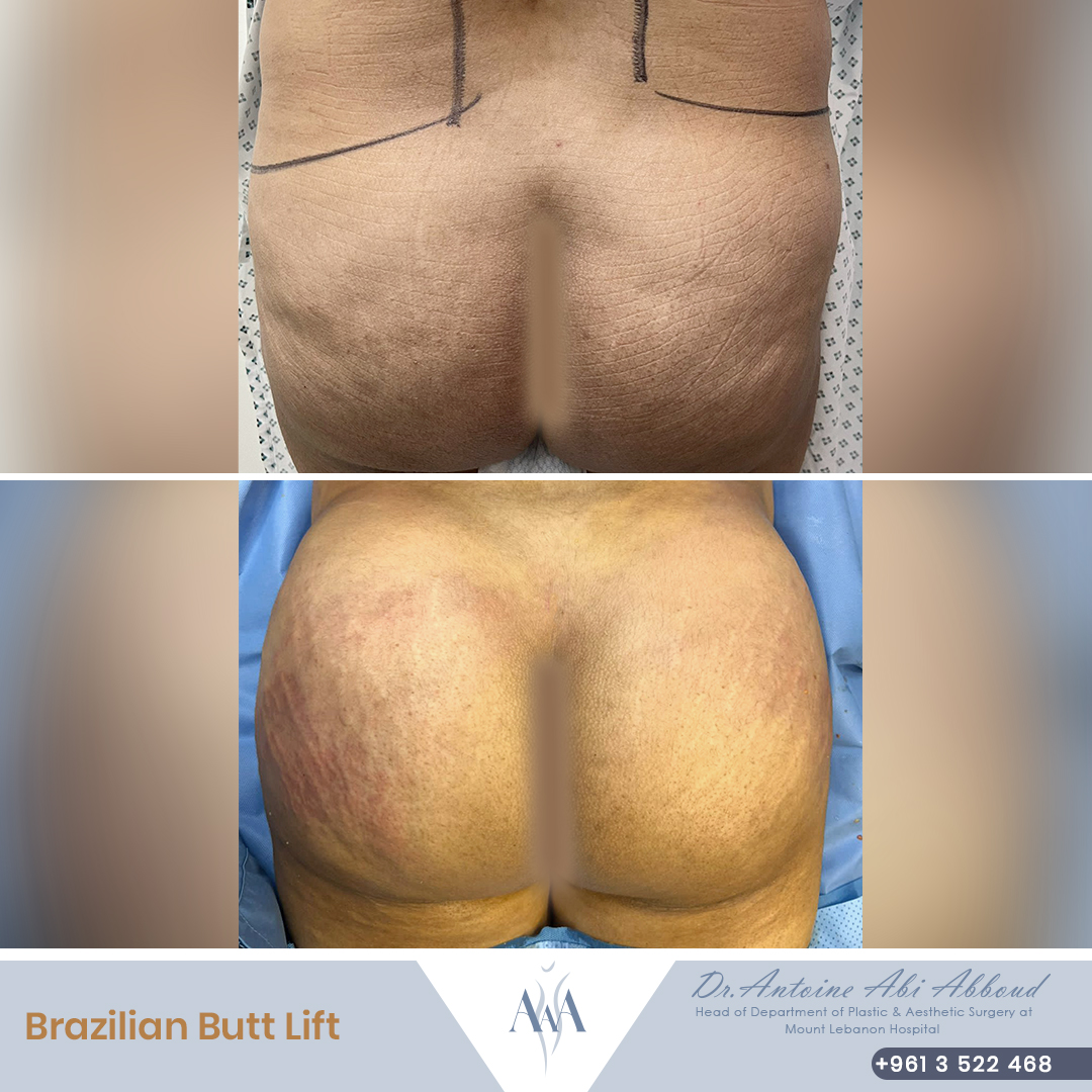 Butt Lipofilling before and after — case 4