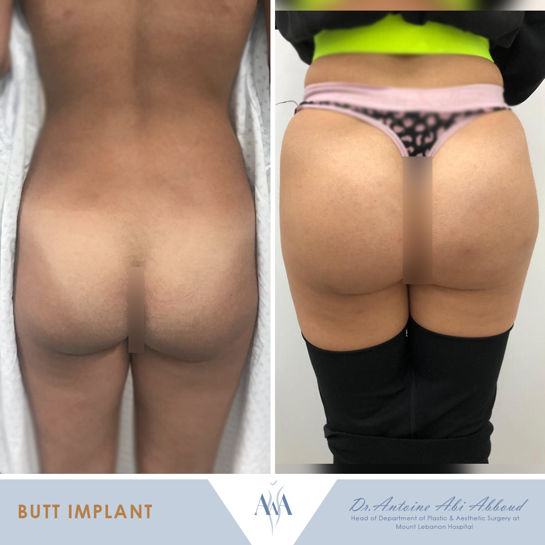 Butt Augmentation before and after — case 8