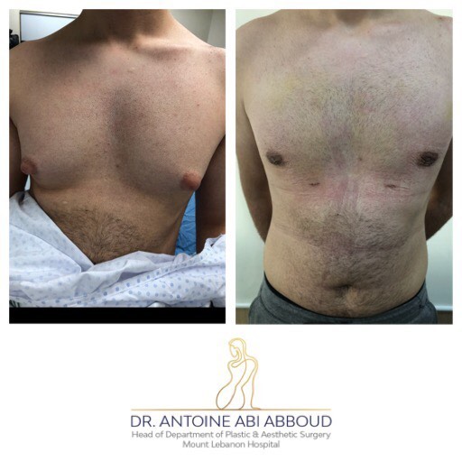 Gynecomastia before and after — case 2