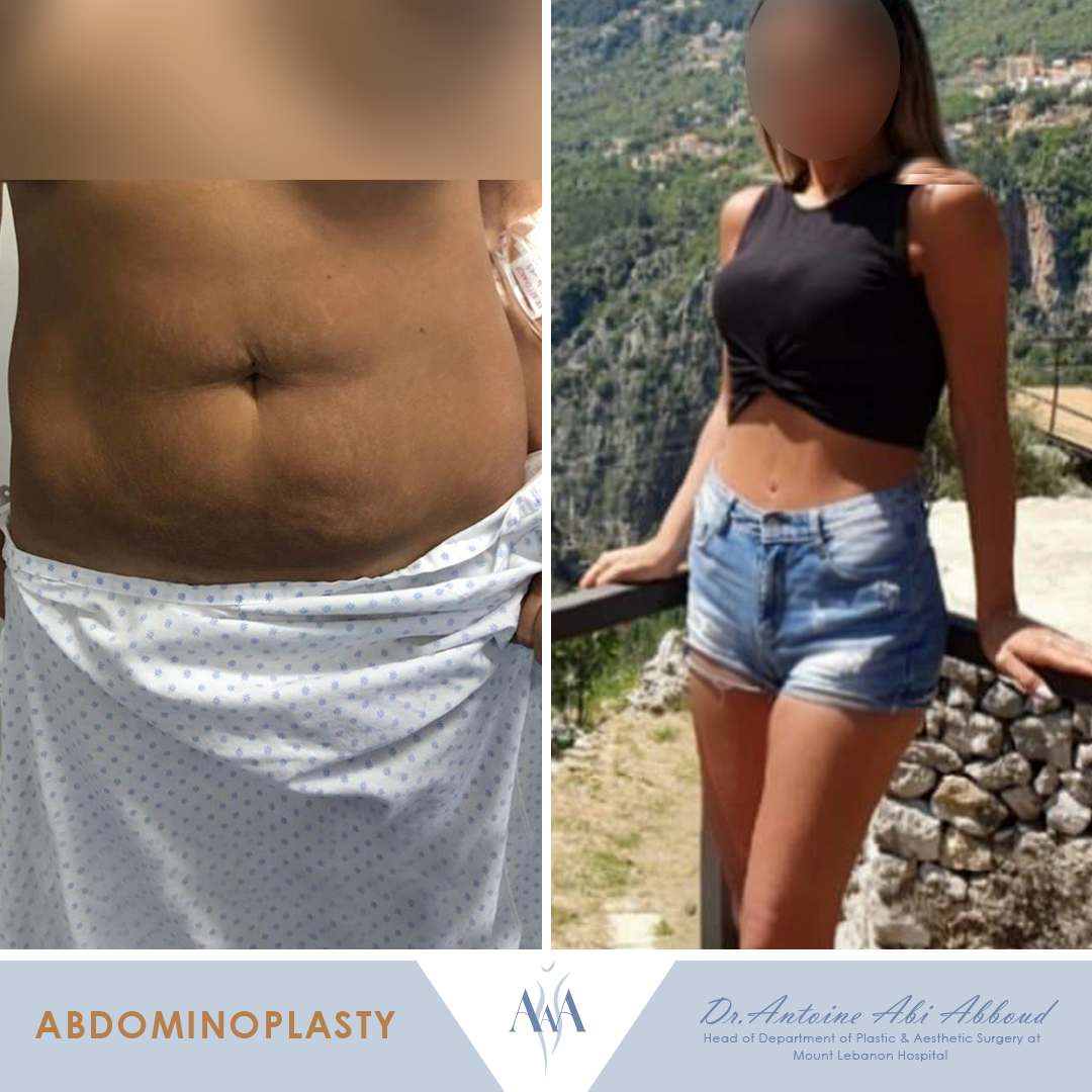 Abdominoplasty before and after — case 5