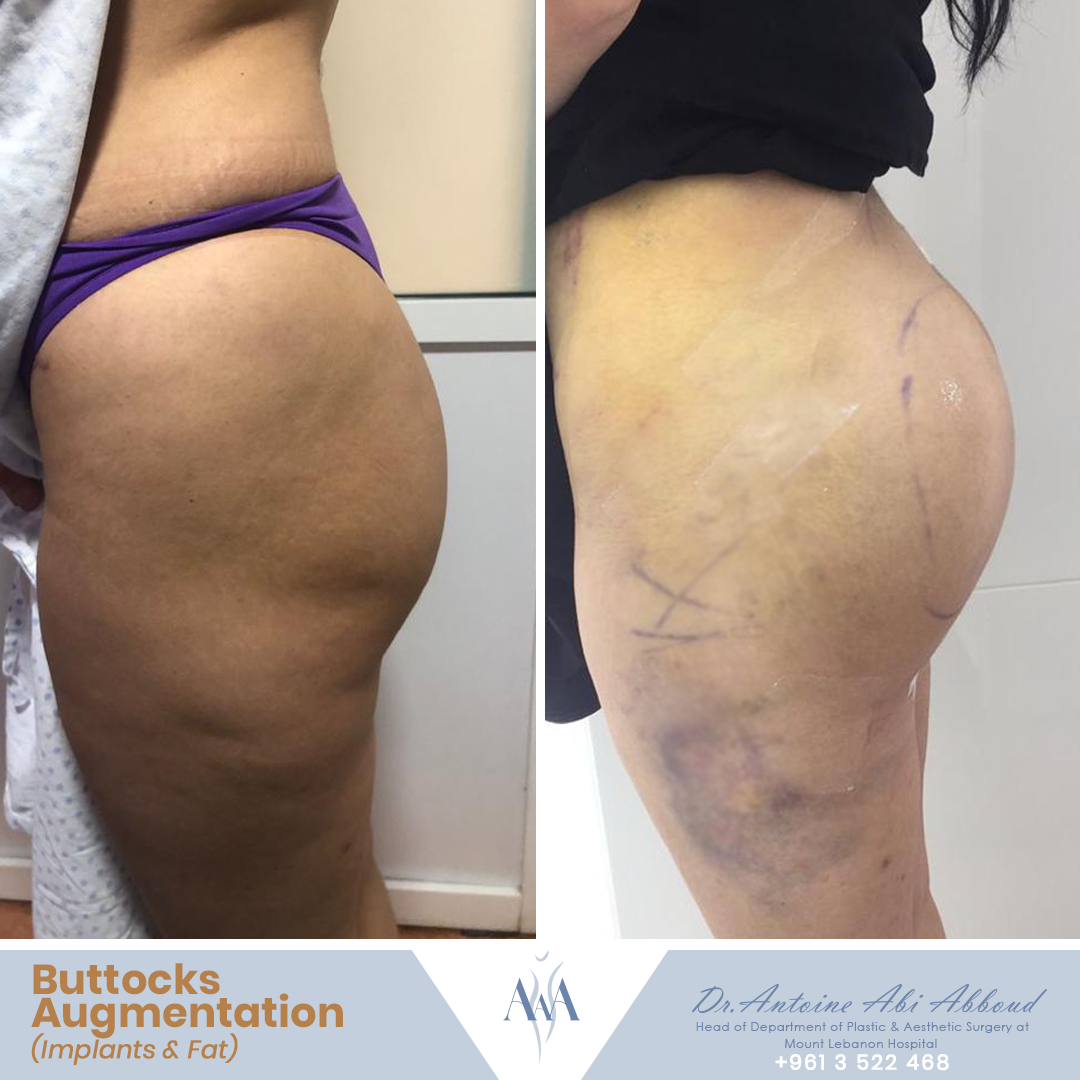 Butt Augmentation before and after — case 7